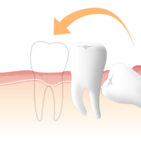 自家歯牙移植治療